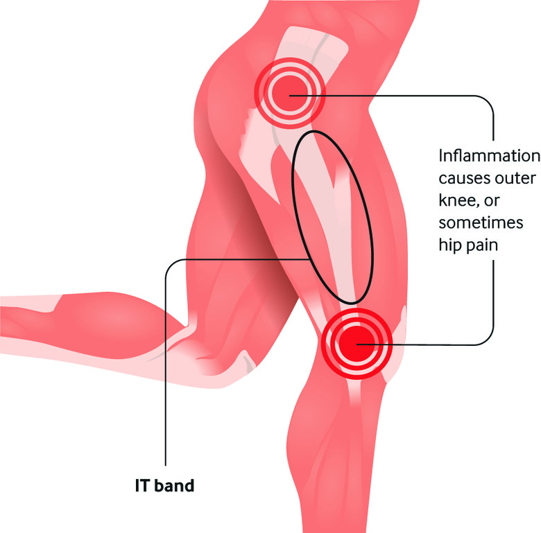 IT Band Syndrome illustration